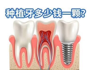 天津种植一颗牙一般需要多少钱费用-种植牙天津多少钱一个