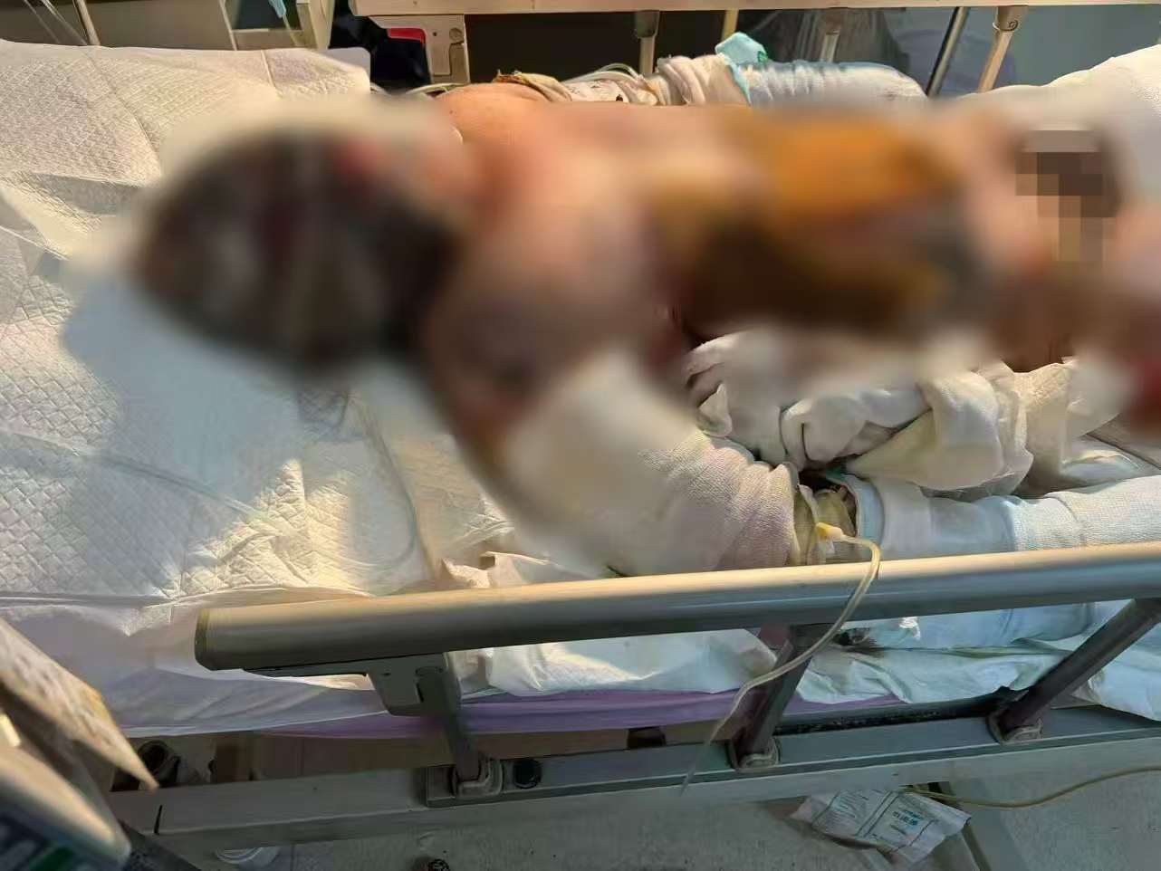 父子在哈尔滨一亲戚公司上班遇爆炸全身烧伤<strong></p>
<p>抹茶交易所</strong>，治疗花费近百万公司拒赔偿？亲戚回应