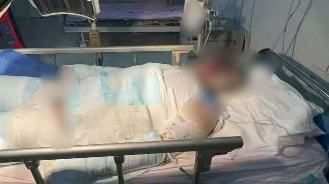 父子在哈尔滨一亲戚公司上班遇爆炸全身烧伤<strong></p>
<p>抹茶交易所</strong>，治疗花费近百万公司拒赔偿？亲戚回应